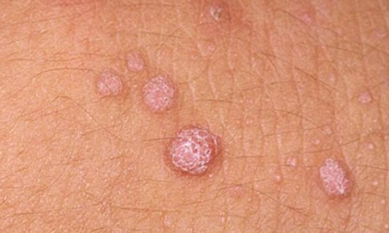 Ο HPV οδηγεί στην εμφάνιση δερματικών θηλωμάτων